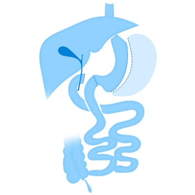 Cruce Duodenal